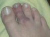 busted toe.jpg