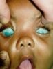 congenital glaucoma.jpg